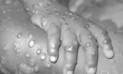 Adamawa Records 5 Case Of Monkey Pox, 57 Suspected Cases In 2 LGAs