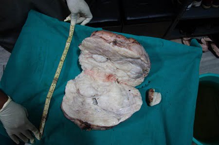 This tumour was removed from Sohana's stomach