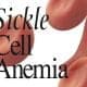 Sickle Cell Patients Should Take Water Often To Replace Lost Cells - Expert