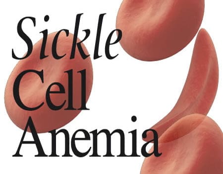 Sickle Cell Patients Should Take Water Often To Replace Lost Cells - Expert