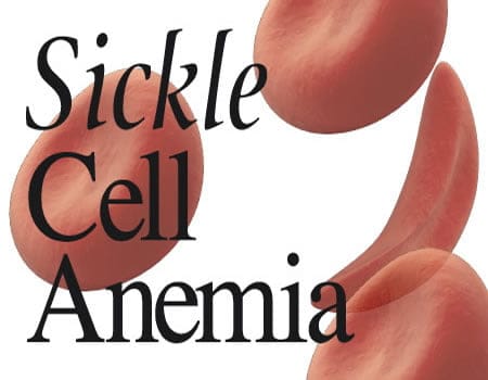 FEC Speed Up Sales Of Sickle Cell Drugs (Niprisan) In Nigeria