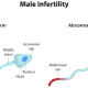 Causes Of Infertility In Men - Expert