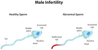 Causes Of Infertility In Men - Expert