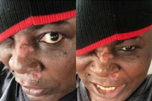 Charly Boy Sustains Injury During Scooter Accident