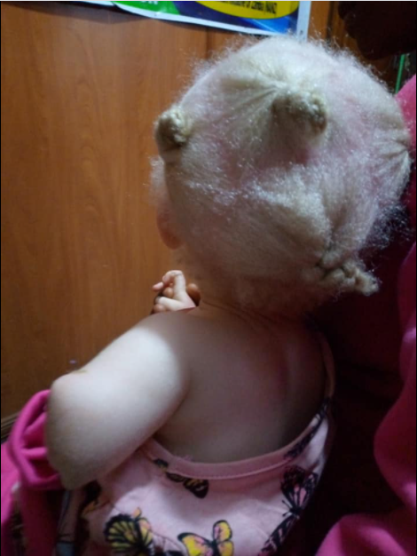 Toddler's Hand Chopped Off By Albino Hunters For Ritual |Photos