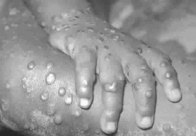 Adamawa Records 5 Case Of Monkey Pox, 57 Suspected Cases In 2 LGAs