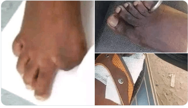 Zimbabwe Citizens Now Selling Their Toes In Exchange For Dollars - Reports