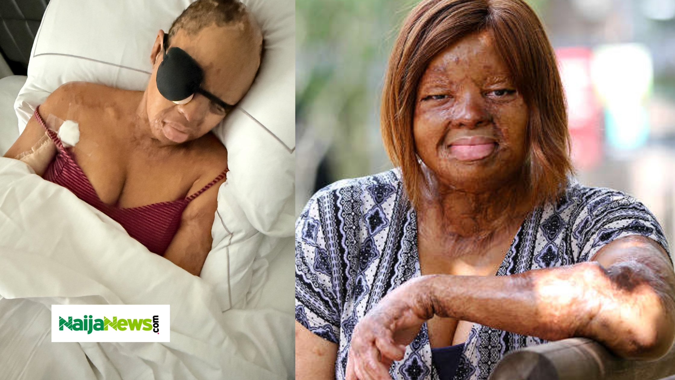‘I Couldn’t Blink Properly’ - Sosoliso Plane Crash Survivor, Kechi, Undergoes Eyelid Surgery